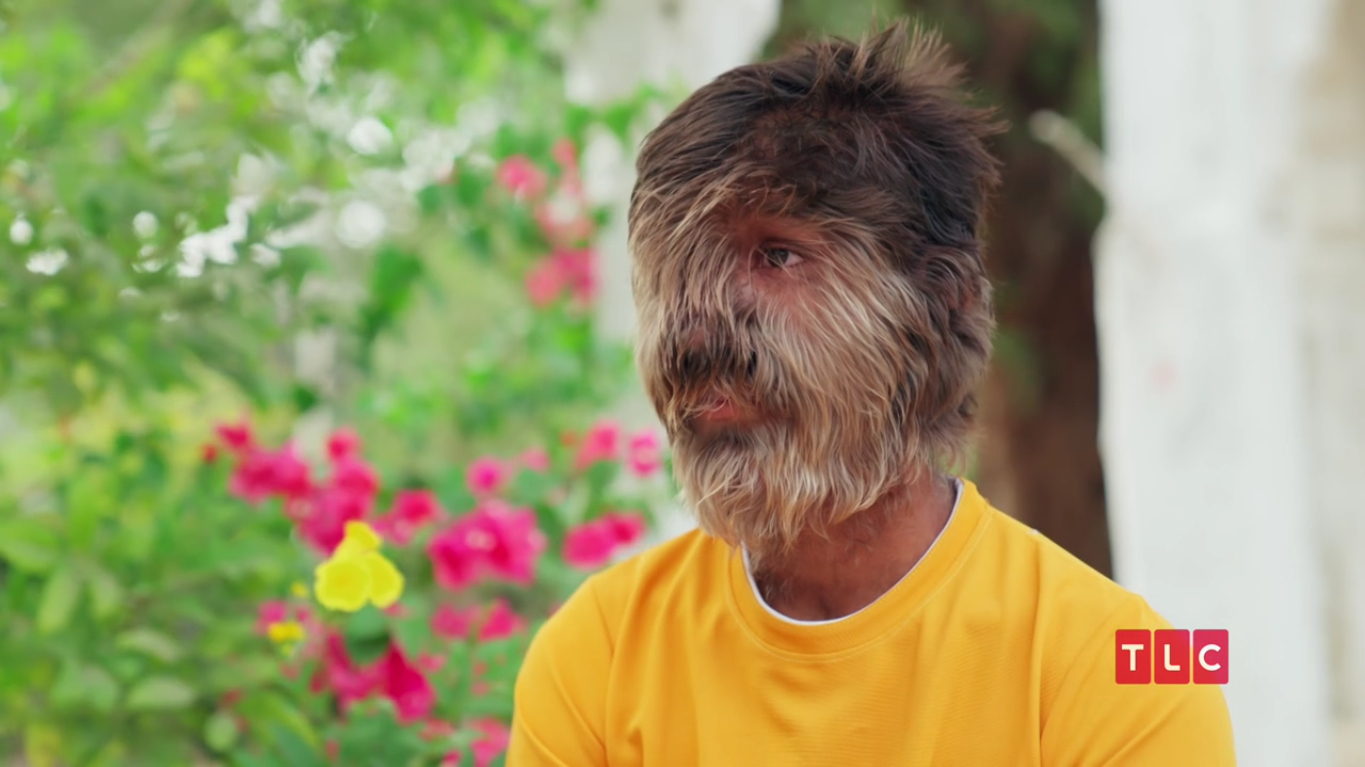 Lalit Patidar: Where is the Man with the Hairiest Face in the World Now?